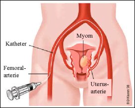 uterus01.jpg