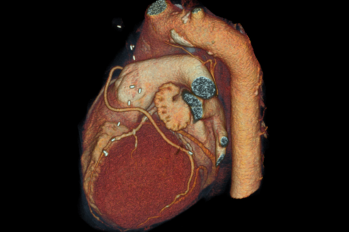 Heart and coronary imaging in computed tomography scanner