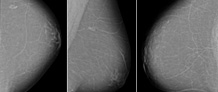 Digitale Mammographie