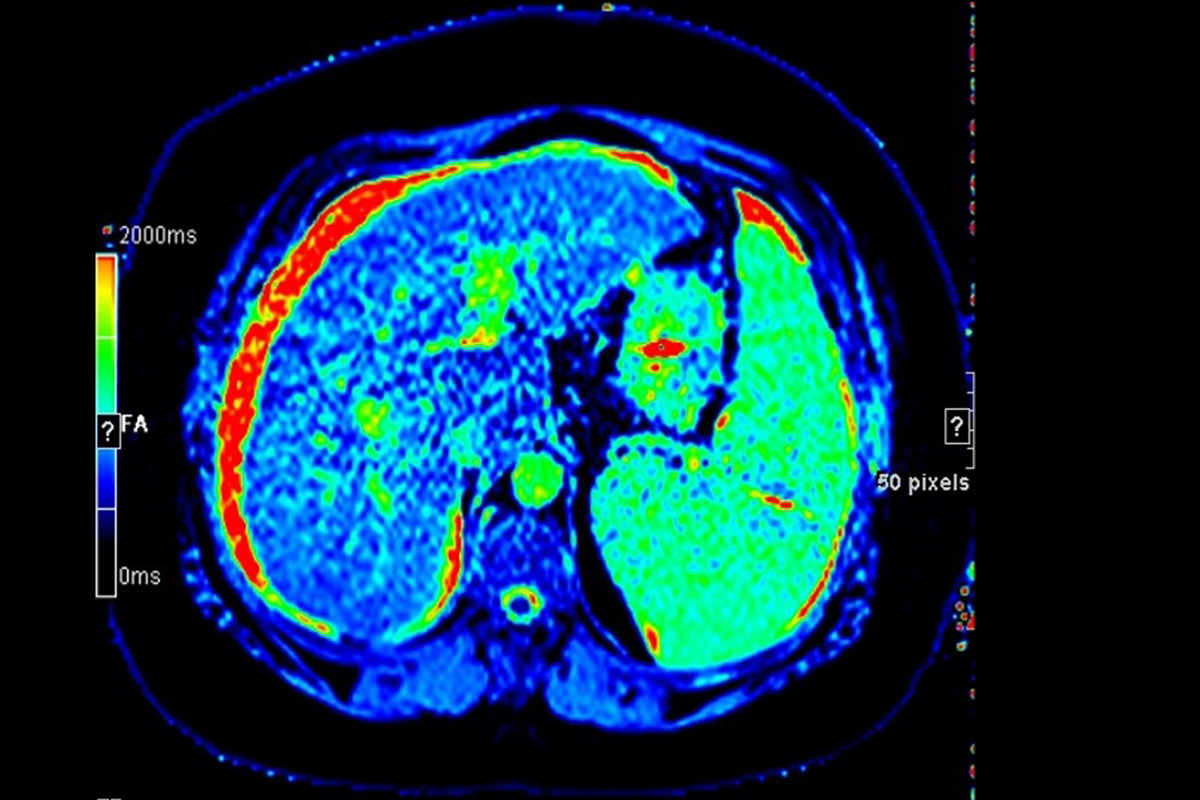 MRI for structural liver diseases