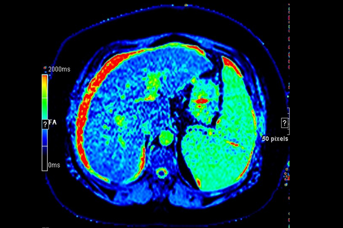 MRI for structural liver diseases