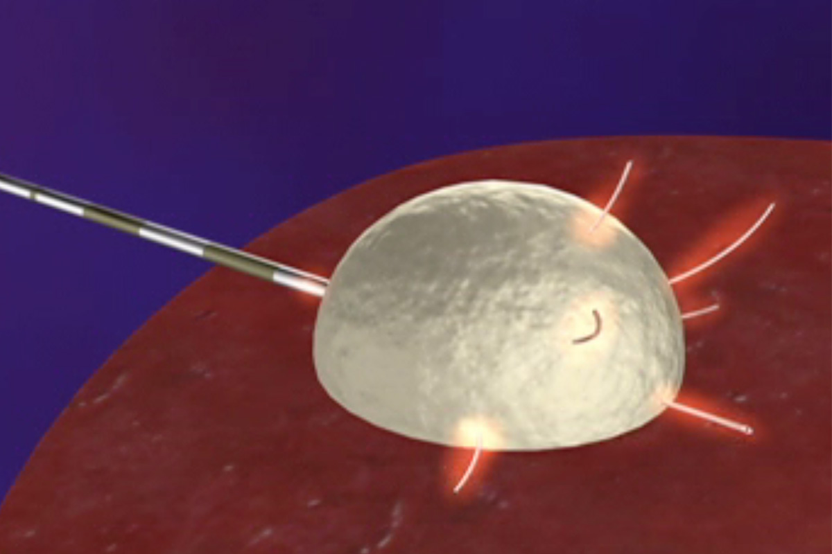 Radiofrequency-Tumor Ablation